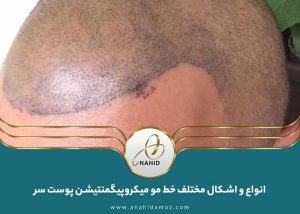 انواع و اشکال مختلف خط مو میکروپیگمنتیشن پوست سر