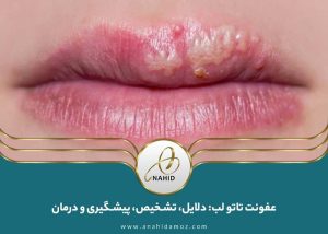 عفونت تاتو لب: دلایل، تشخیص، پیشگیری و درمان