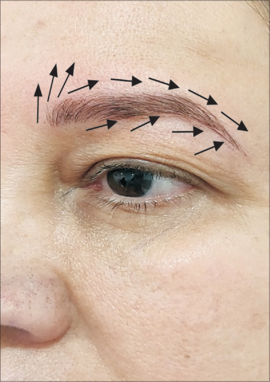 طراحی ضربات در میکروبلیدینگ