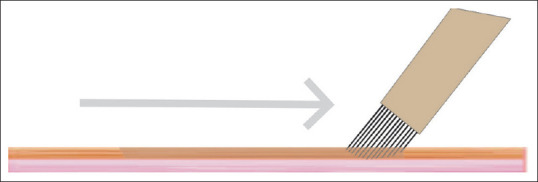 نحوه انجام میکروبلیدینگ