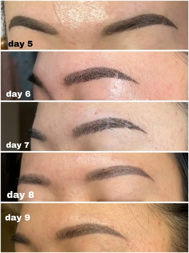 در روزهای 5 تا 9 بعد ار میکروبلیدینگ​